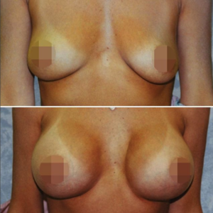 Breast Augmentation Before & After