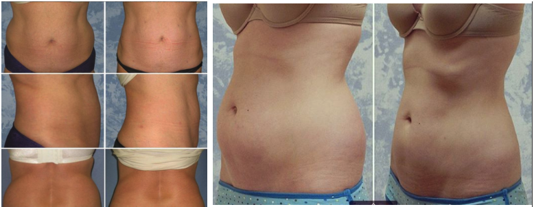 Liposuction Before & After procedure results