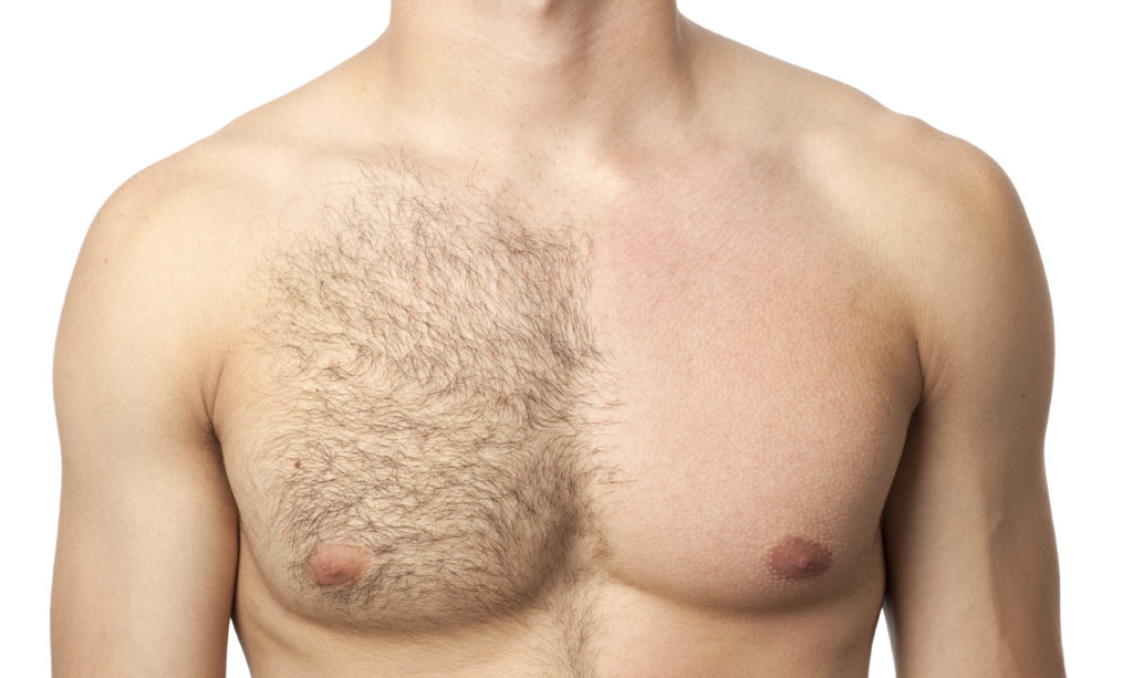 Male Laser Hair Removal Lewisville TX