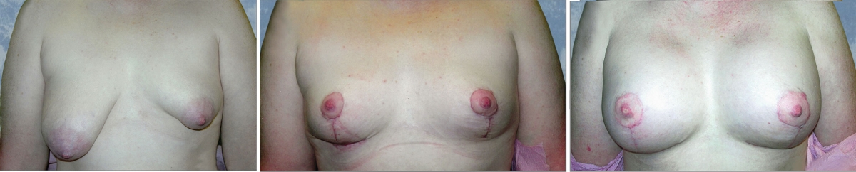 Breast Lift Reduction