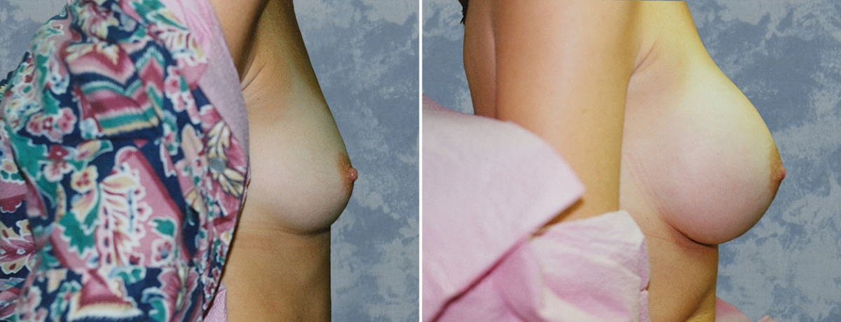 Breast Augmentation