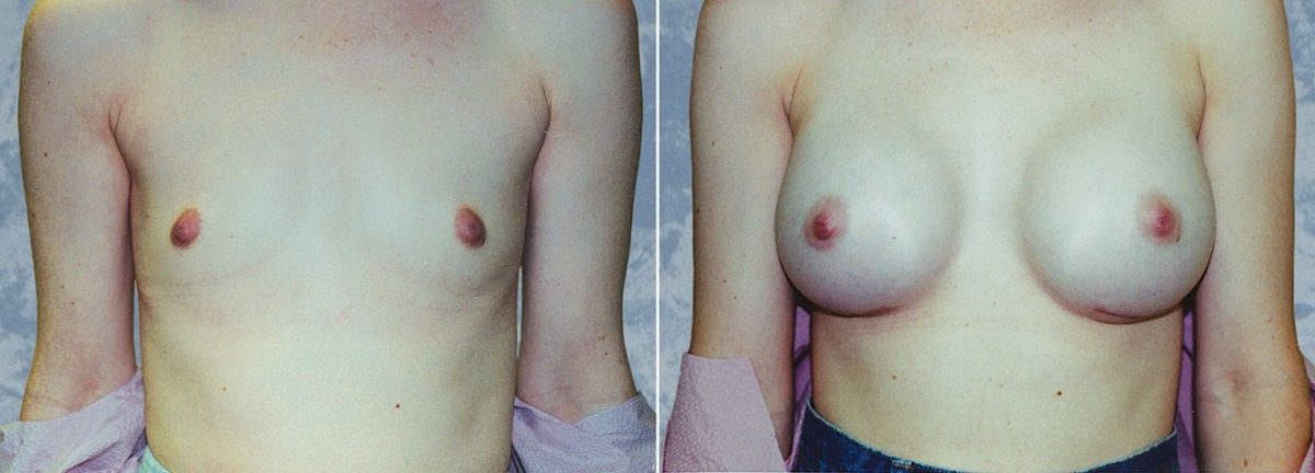 Breast Augmentation