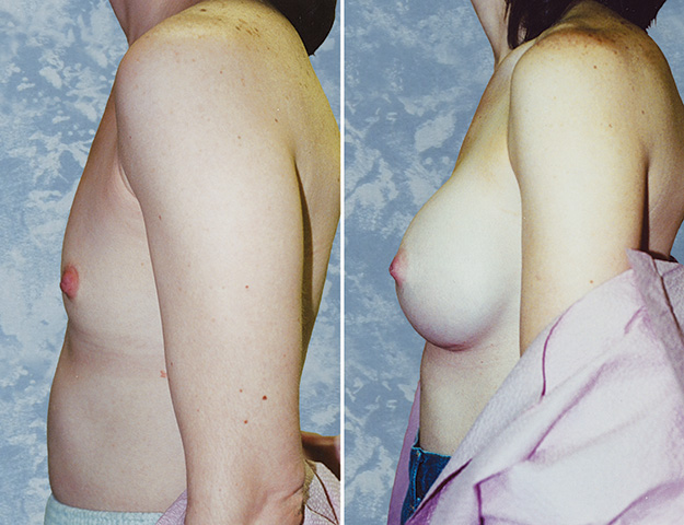 Breast Augmentation
