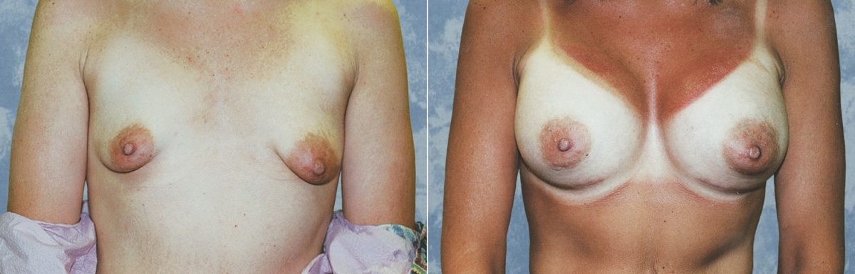 Breast Augmentation