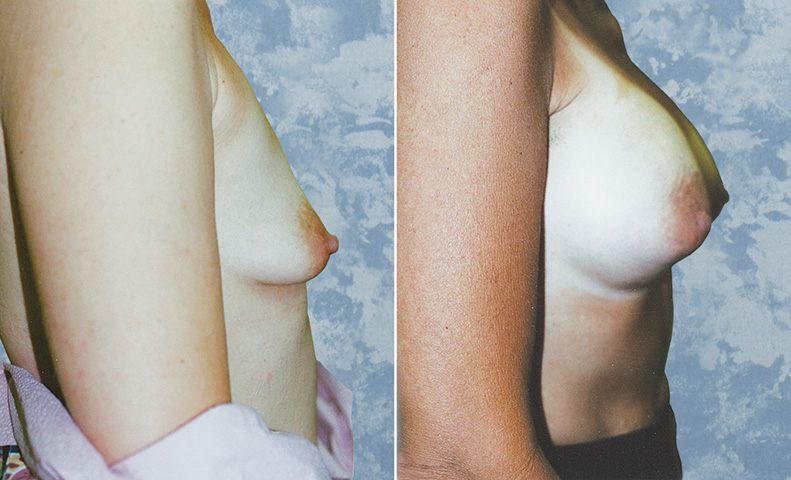 Breast Augmentation
