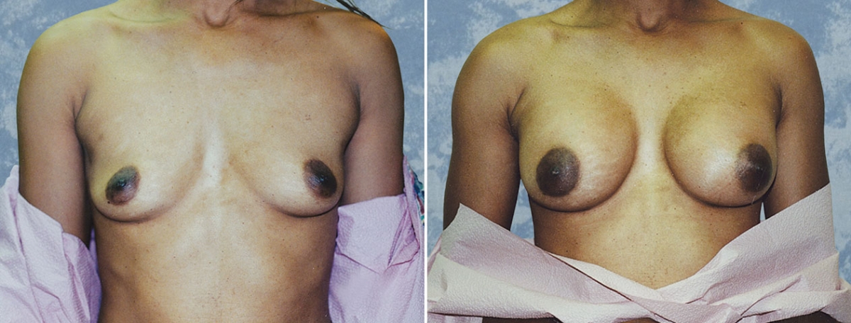Breast Augmentation