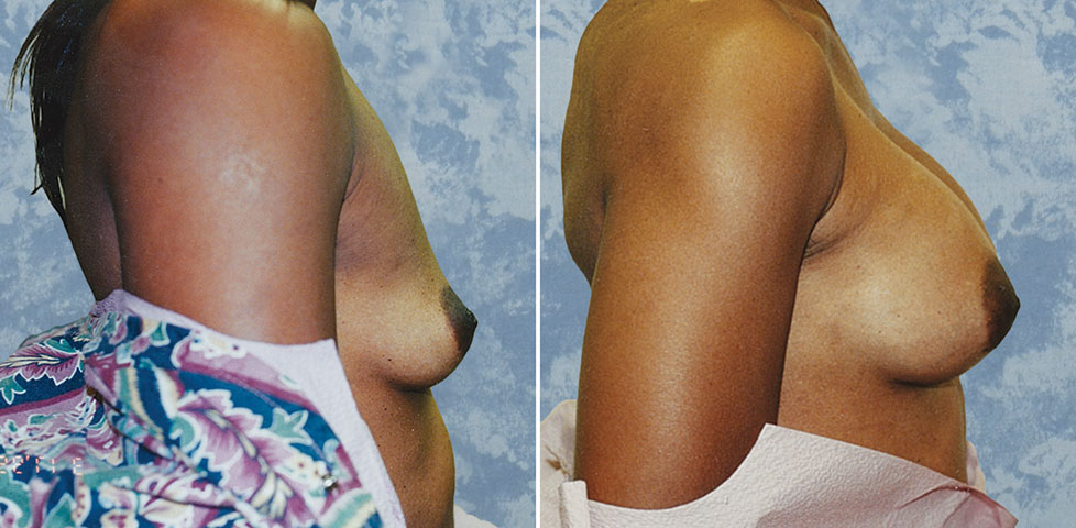 Breast Augmentation