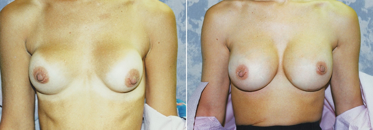 Breast Augmentation