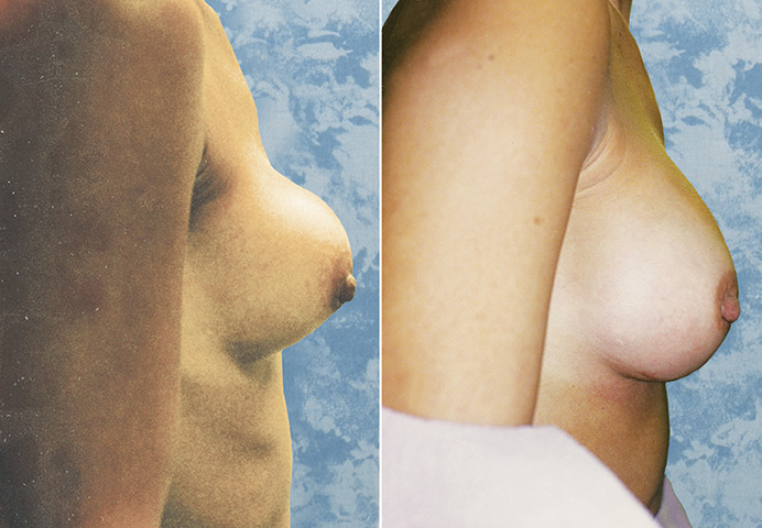 Breast Augmentation