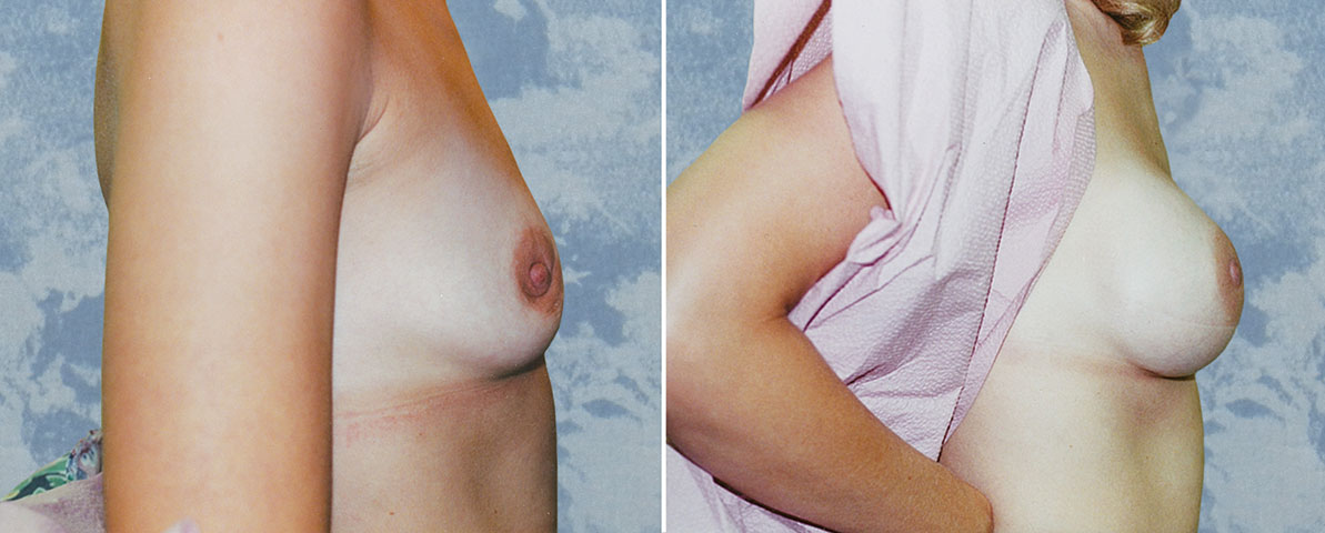 Breast Augmentation