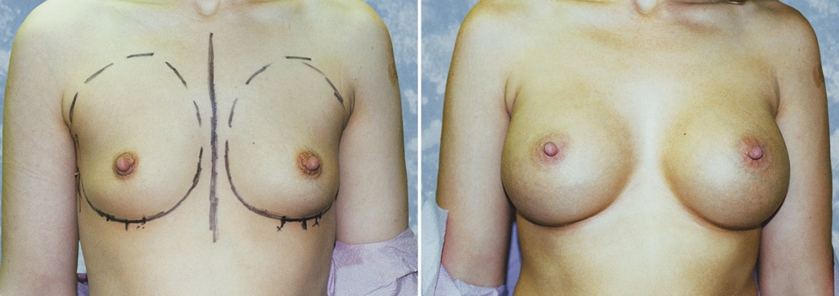 Breast Augmentation