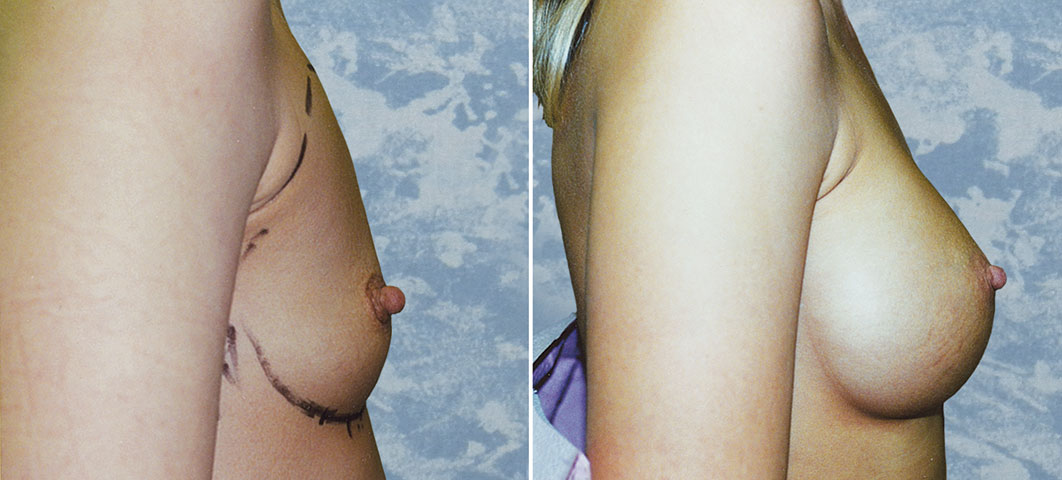 Breast Augmentation