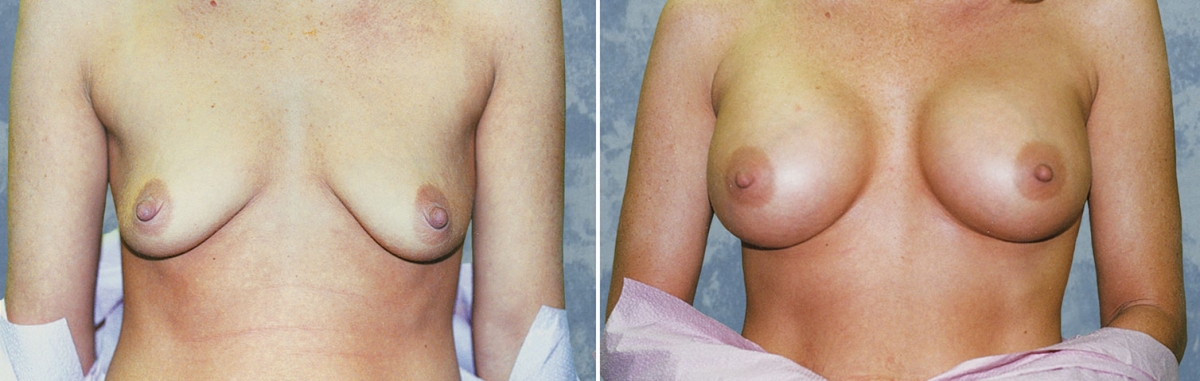 Breast Augmentation