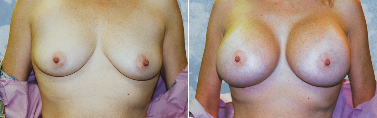 Breast Augmentation