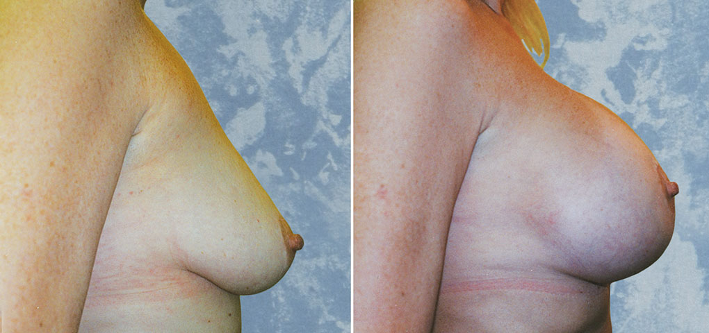 Breast Augmentation