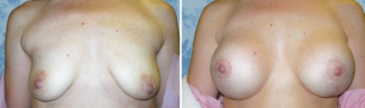 Breast Lift Reduction
