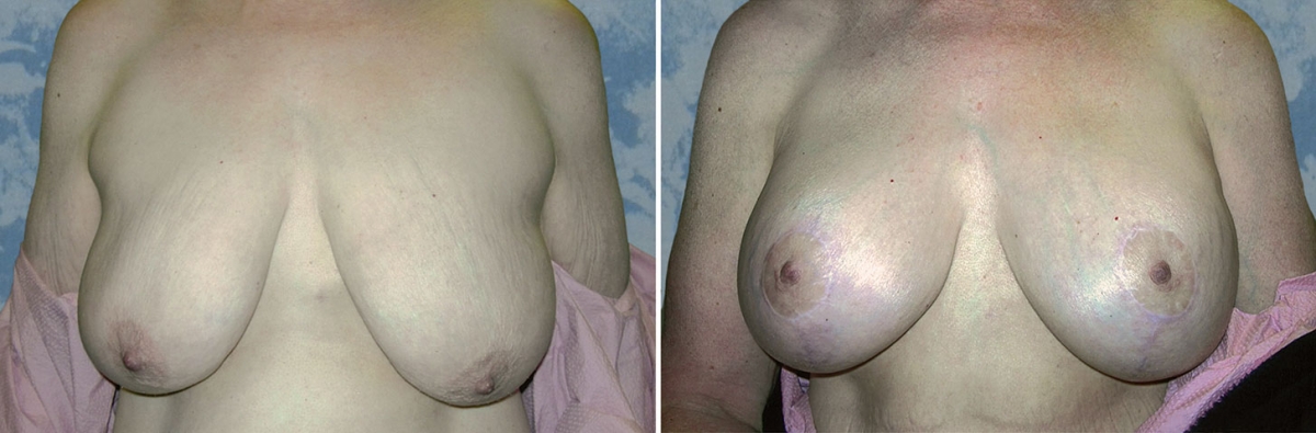 Breast Lift Reduction