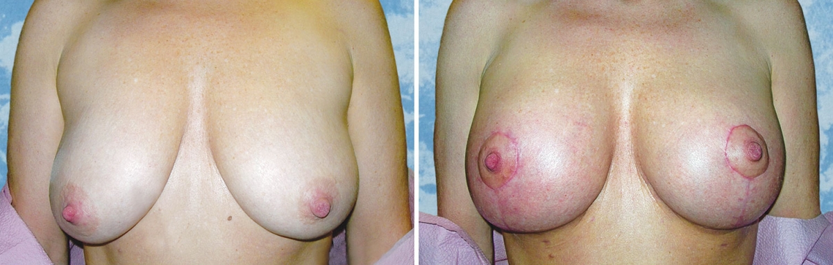 Breast Lift Reduction