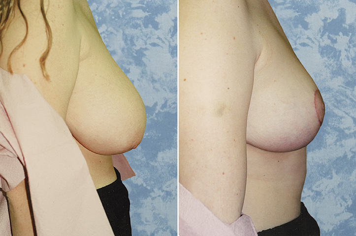 Breast Lift Reduction