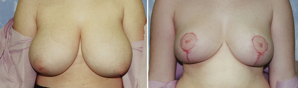 Breast Lift Reduction