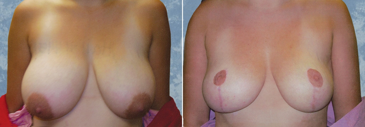 Breast Lift Reduction