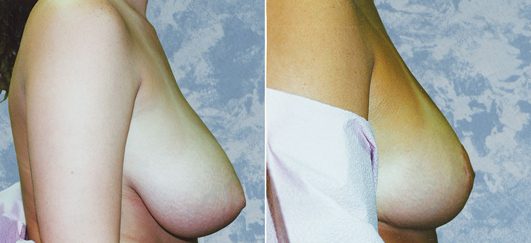 Breast Lift Reduction