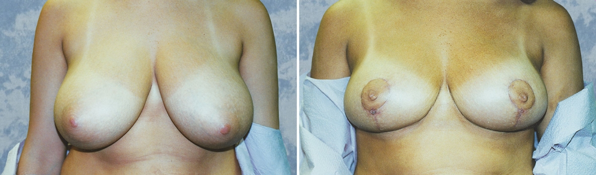 Breast Lift Reduction