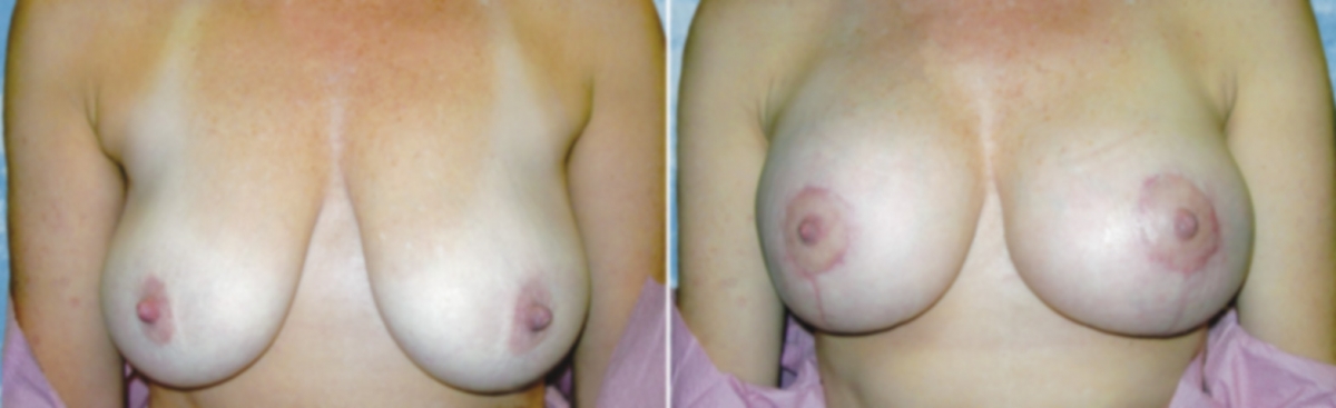 Breast Lift Reduction