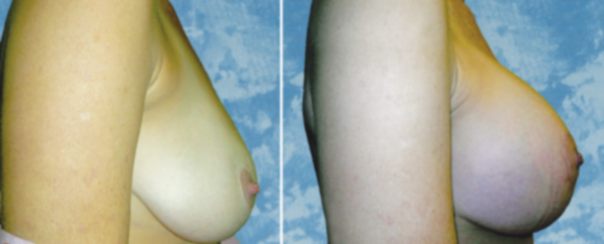 Breast Lift Reduction