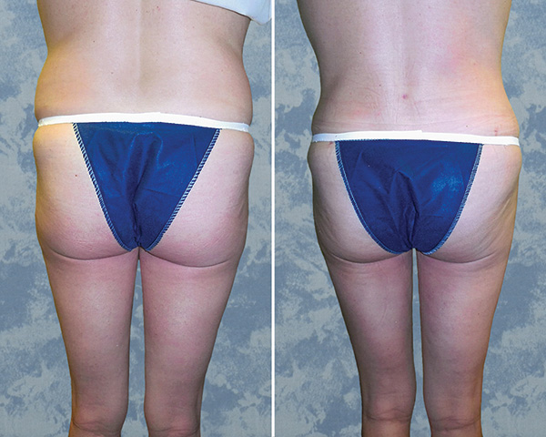 Abdominoplasty Tummy Tuck