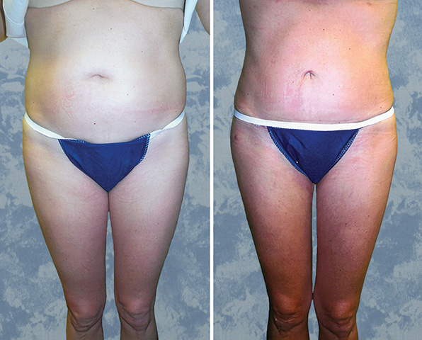 Abdominoplasty Tummy Tuck