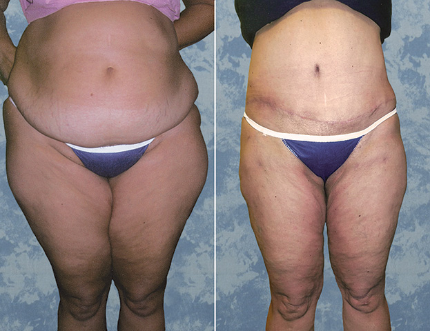 Abdominoplasty Tummy Tuck