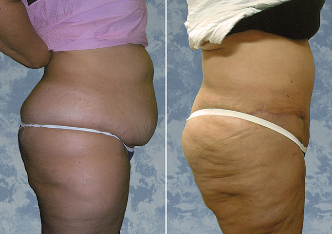 Abdominoplasty Tummy Tuck