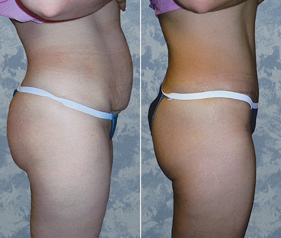 Abdominoplasty Tummy Tuck