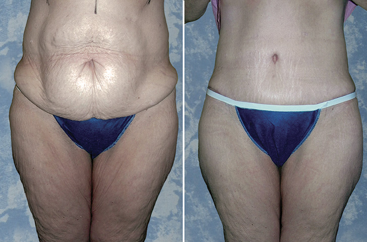 Abdominoplasty Tummy Tuck