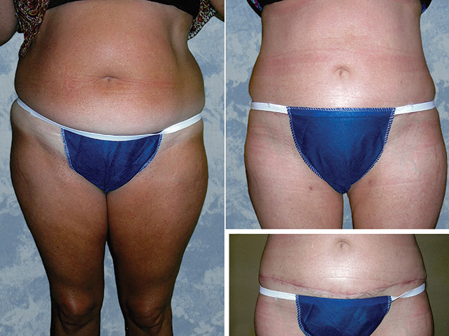 Abdominoplasty Tummy Tuck