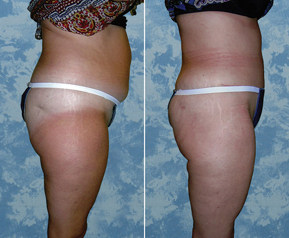 Abdominoplasty Tummy Tuck