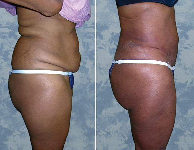 Abdominoplasty Tummy Tuck