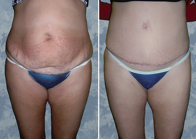 Abdominoplasty Tummy Tuck