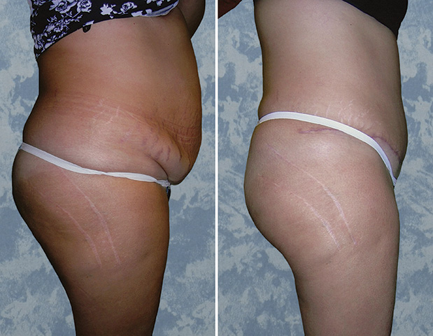 Abdominoplasty Tummy Tuck