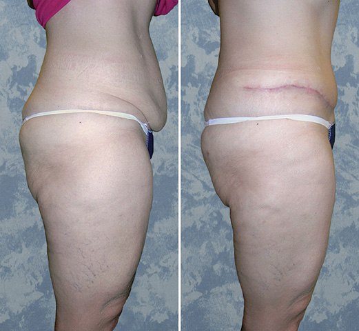 Abdominoplasty Tummy Tuck