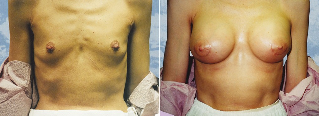 Breast Augmentation