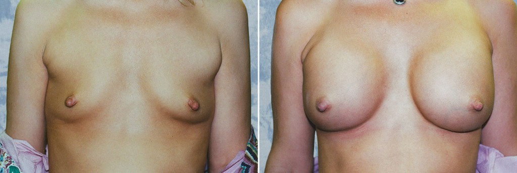 Breast Augmentation