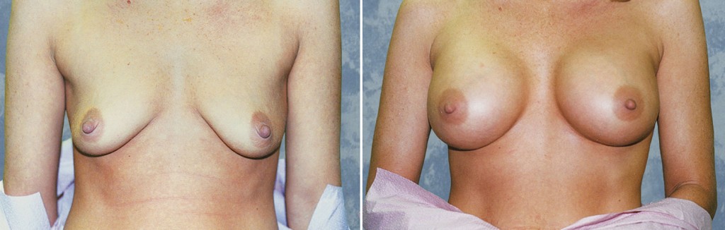 Breast Augmentation
