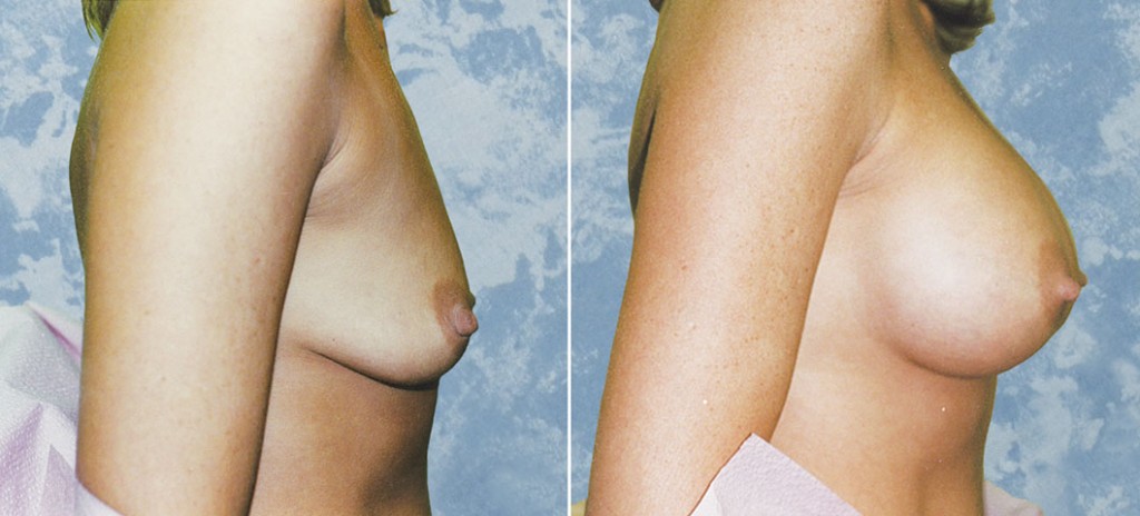 Breast Augmentation