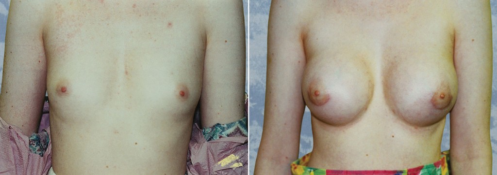Breast Augmentation
