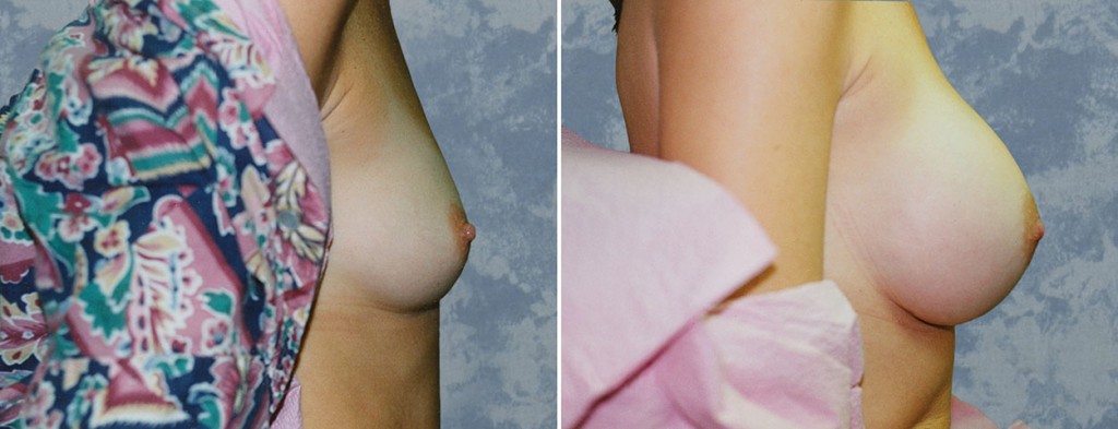 Breast Augmentation