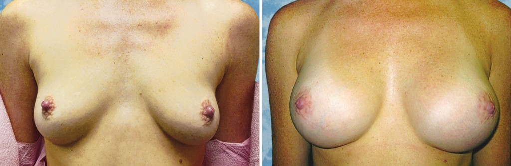 Breast Augmentation