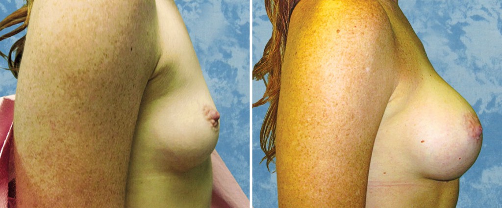 Breast Augmentation