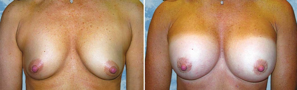 Breast Augmentation